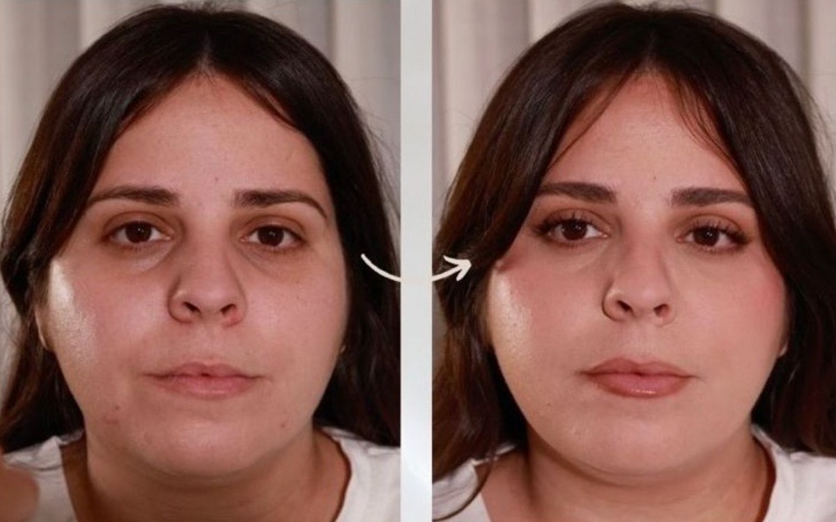 Antes e depois, olheiras fundas