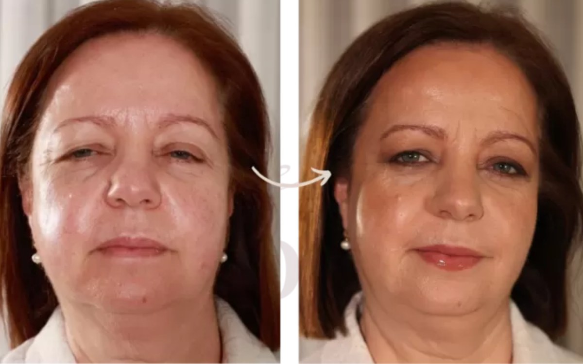 Antes e depois, pele madura
